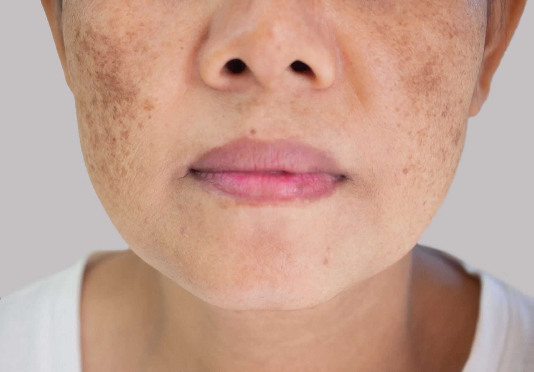 Traitement des taches pigmentaires visage et corps | Dr Kathleen Scemama | Paris 12