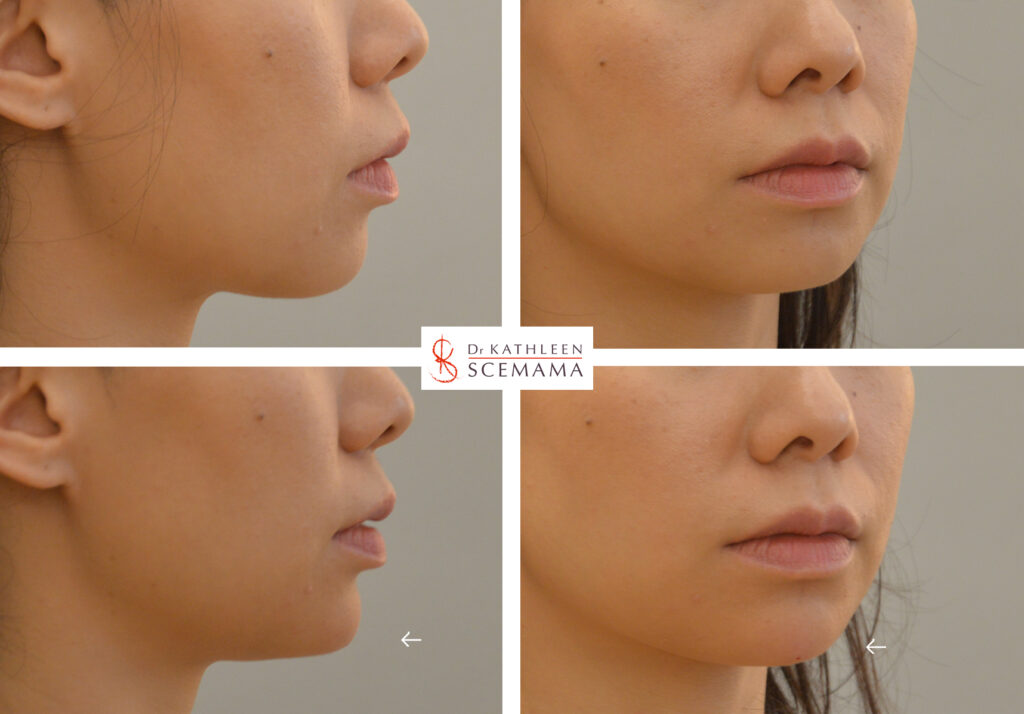 Génioplastie médicale : acide hyaluronique menton | Paris | Dr Scemama