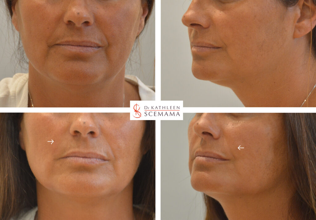 Sillons nasogéniens injections acide hyaluronique Paris Dr Scemama