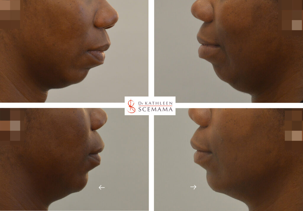 Génioplastie médicale : acide hyaluronique menton | Paris | Dr Scemama