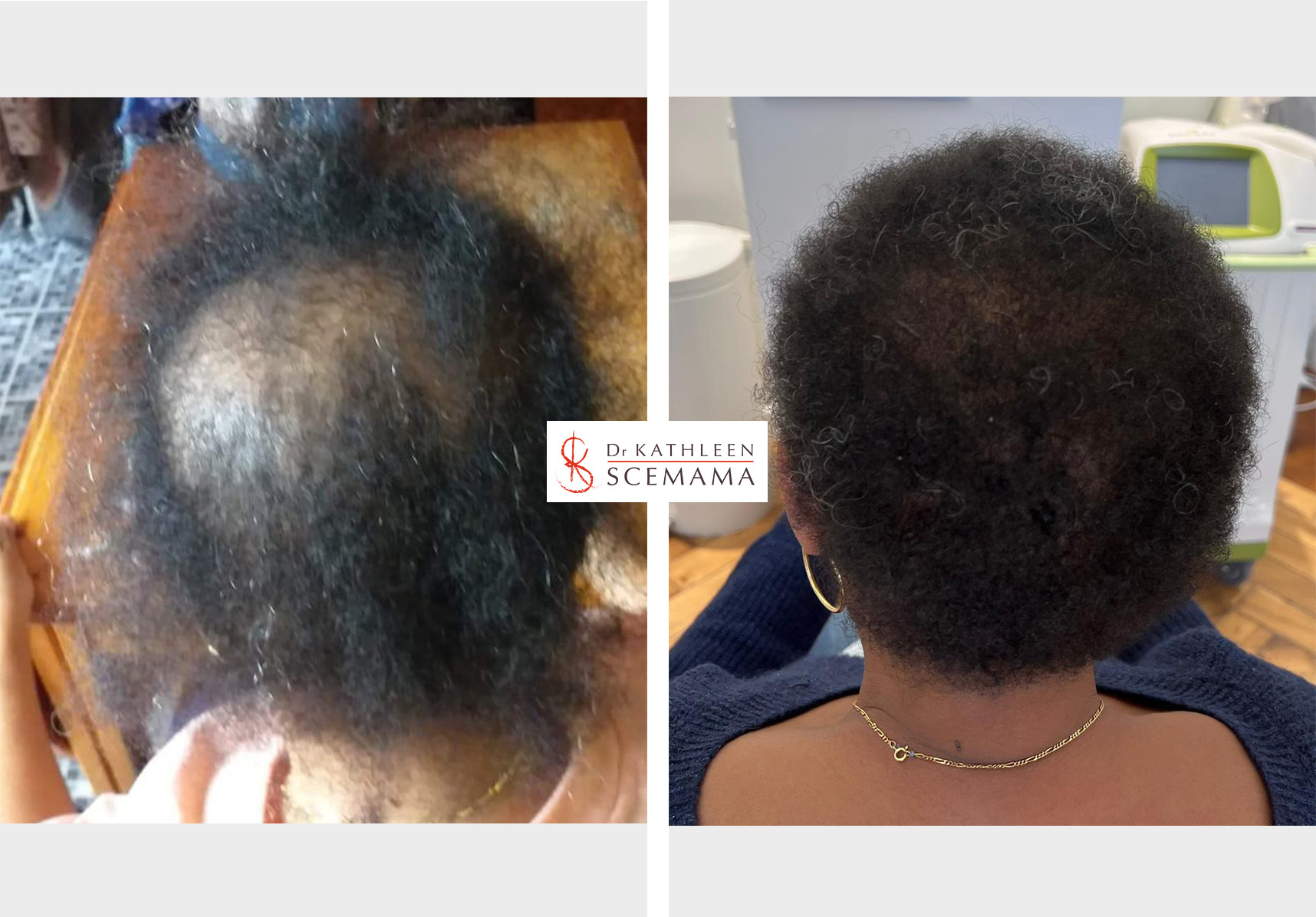 Avant - Après dermatologie des cheveux | Dermatologie médical du cuir chevelu | Dr Kathleen Scemama