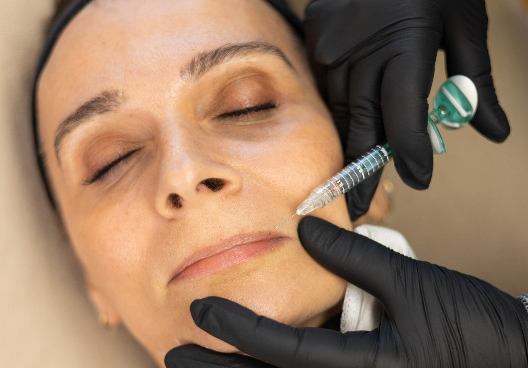 Injections d'acide hyaluronique pour les lèvres | Paris | Dr Kathleen Scemama
